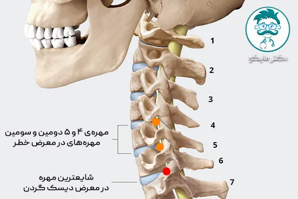 علائم پارگی دیسک گردن