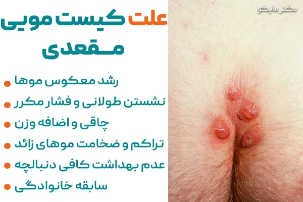 علت کیست مویی مقعدی