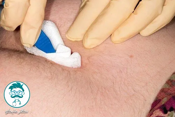 آیا کیست مویی میتواند سرطانی شود؟