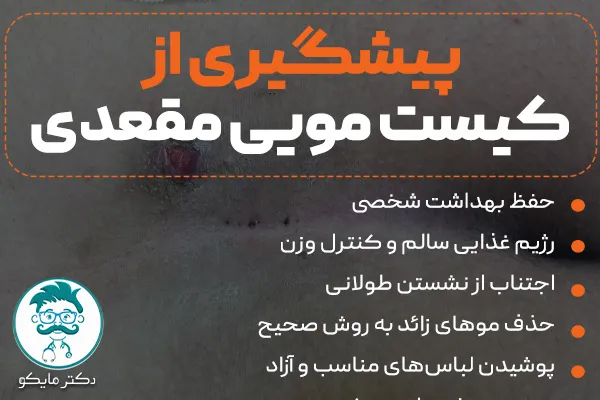 پیشگیری از کیست مویی مقعدی