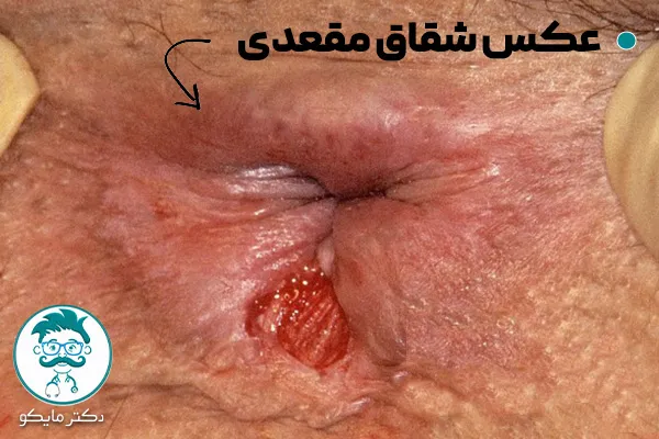عکس شقاق مقعدی