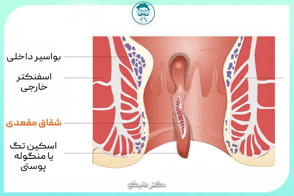تفاوت شقاق با بواسیر