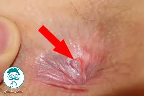 تشخیص فیشر مقعدی