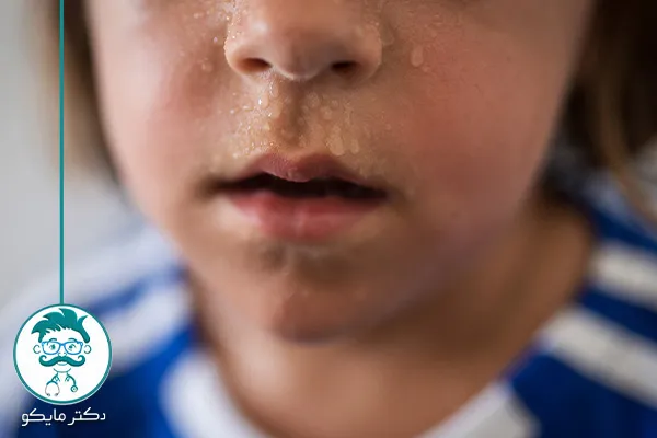 عرق سرد در کودکان