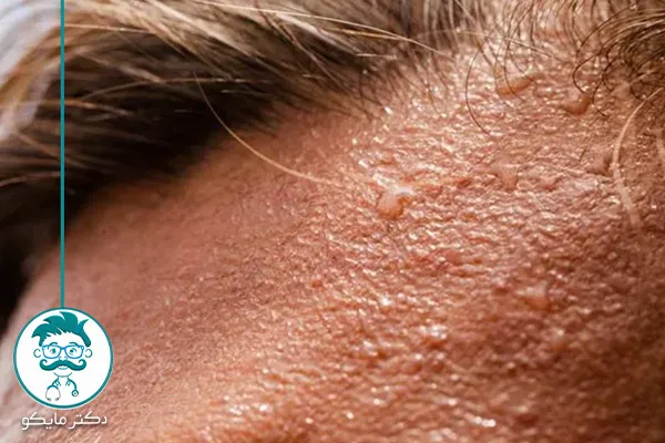 علت عرق کردن در نواحی مختلف بدن