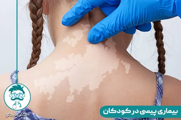 درمان بیماری پیسی