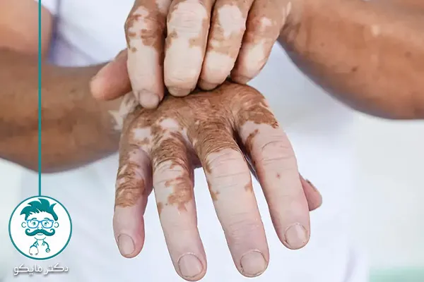 تغییر رنگ پوست در پیسی