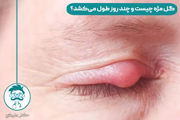 چرا گل مژه میزنیم و چند روزه خوب میشود؟