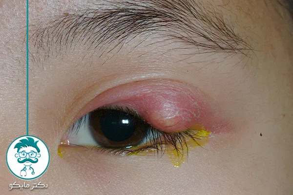 علت: چرا گل مژه میزنیم؟