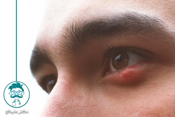 علت گل مژه زیر چشم