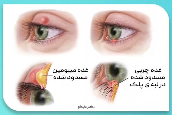 گل مژه چیست؟