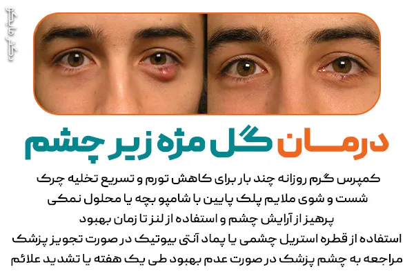 درمان گل مژه زیر چشم