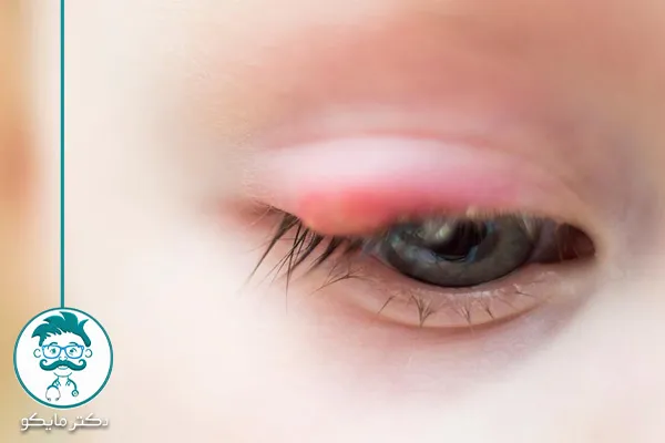 درمان خانگی گل مژه