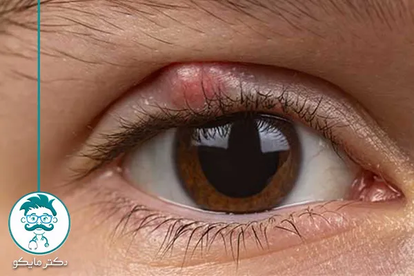 پیشگیری از گل مژه