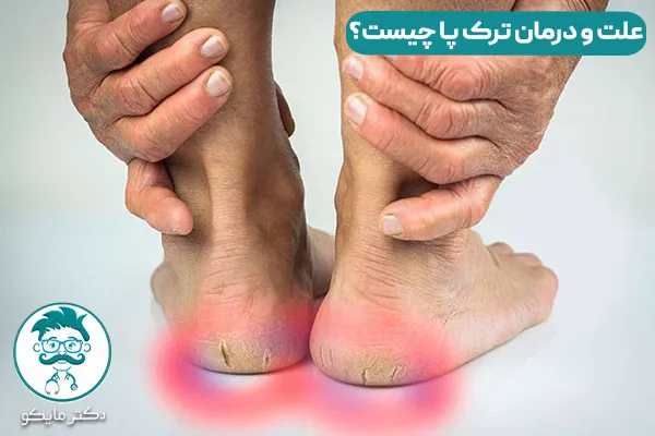 ترک پا چیست؟