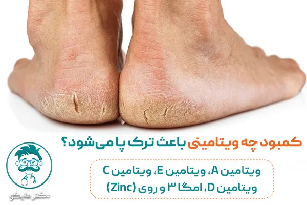کمبود چه ویتامینی باعث ترک کف پا می‌شود؟