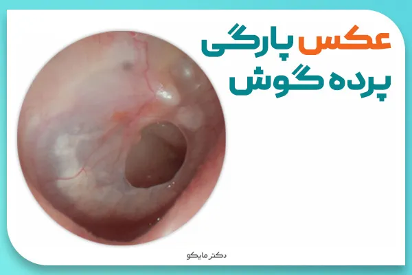عکس پارگی گوش